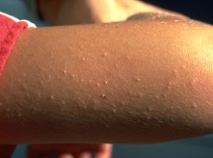 keratosis-pilaris